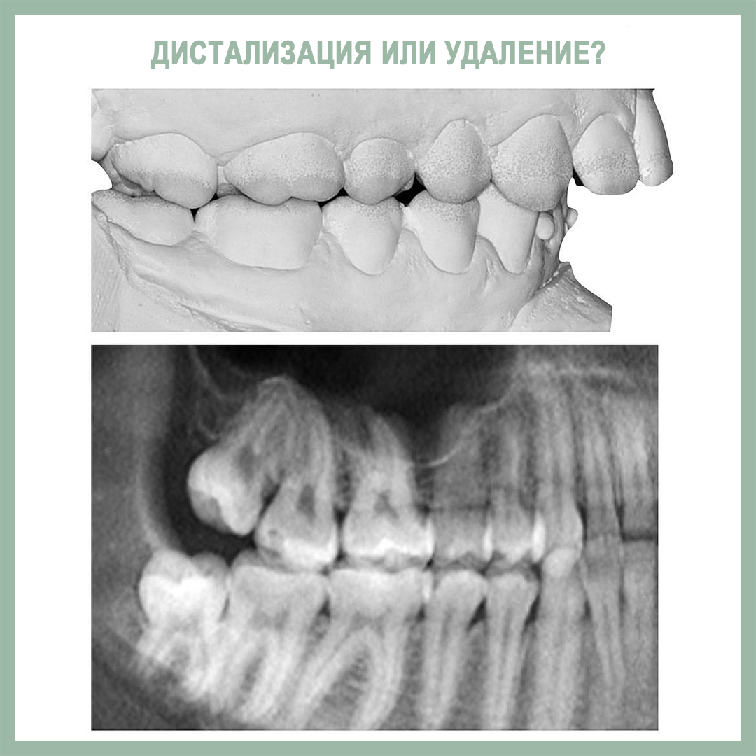 Дистализация или удаление? - интересно об ортодонтии, имплантации и  протезировании зубов